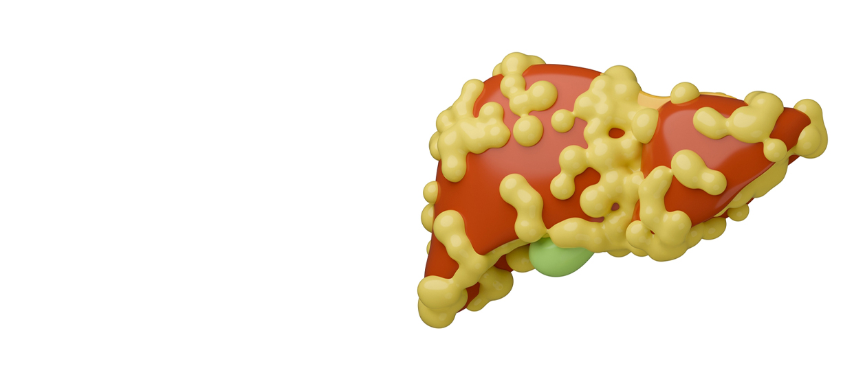 Comprehensive Non-Alcoholic Steatohepatitis Treatment in Lucknow